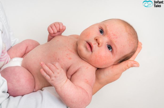 Baby Heat Rash