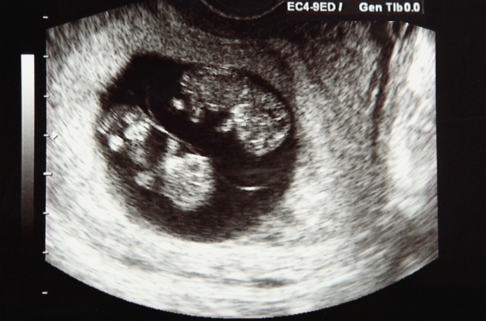 7 Weeks Pregnant With Twins Ultrasound